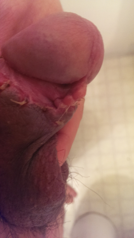 Swollen Penis After Circumcision 77