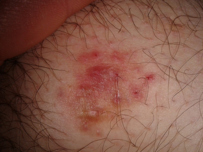 Spots And Scabs That Wont Heal Fungal And Yeast Infections