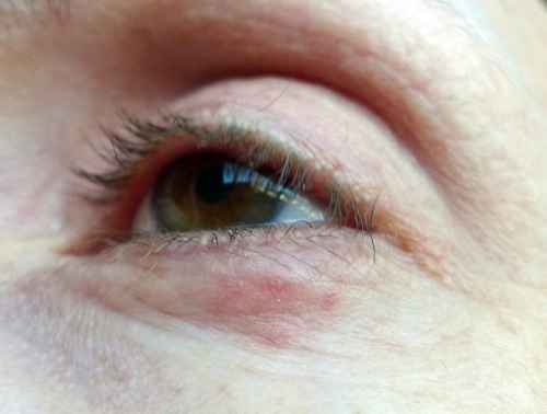skin growth on eyelid
