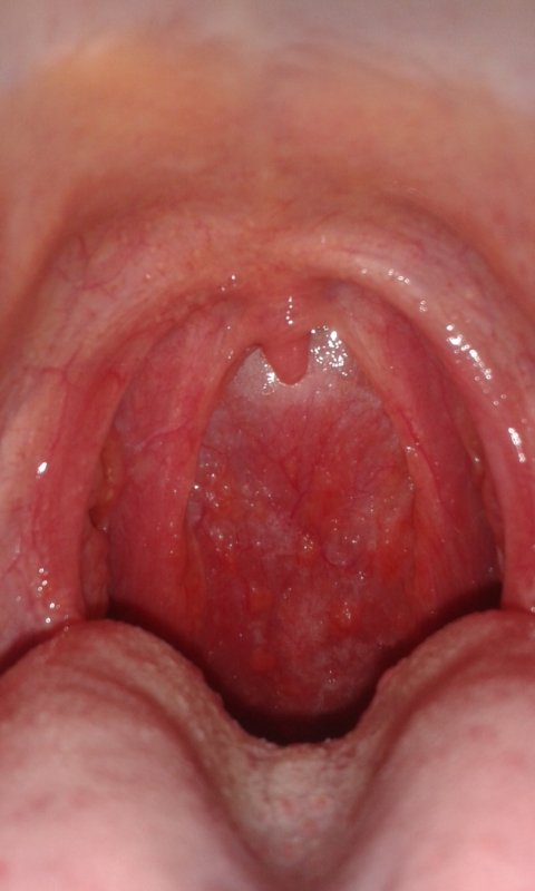 Red Bump Back Of Throat 40