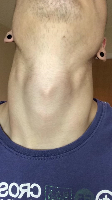 where are lymph nodes in neck