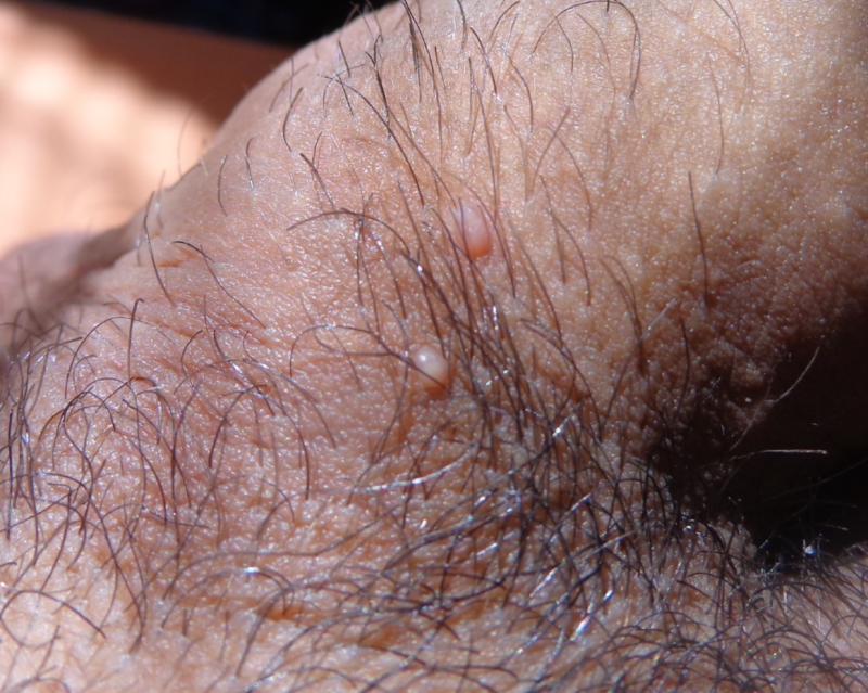 Penile whiteheads shaft on Pimples and