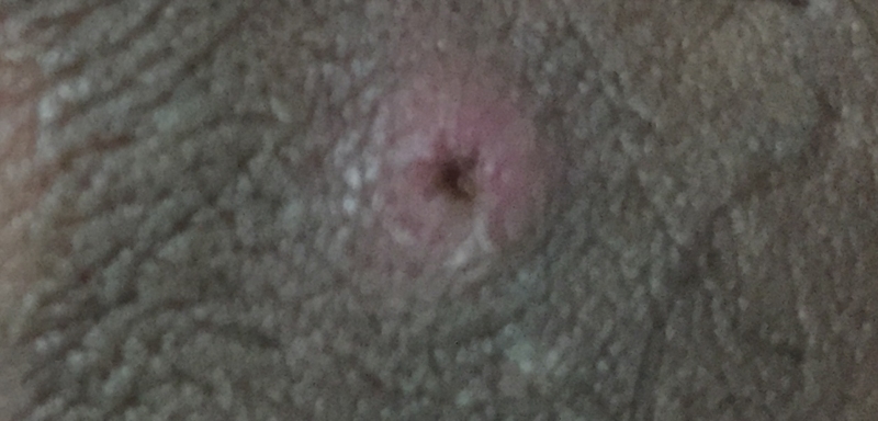 Itchy penis hole