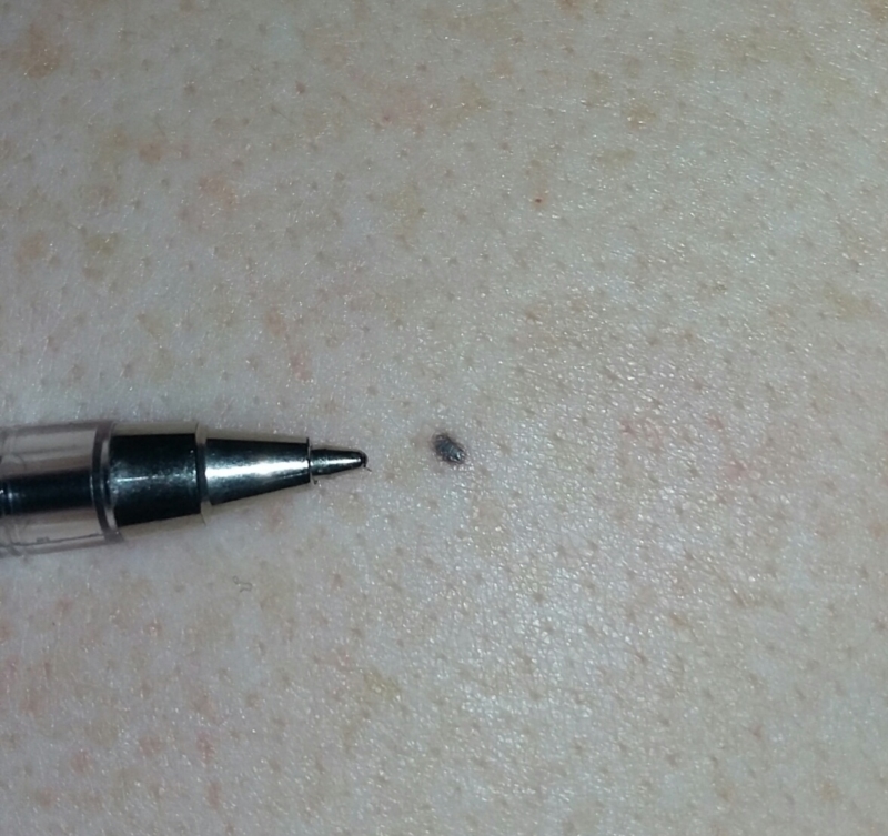 small black spot found on upper back | Cancer | Patient