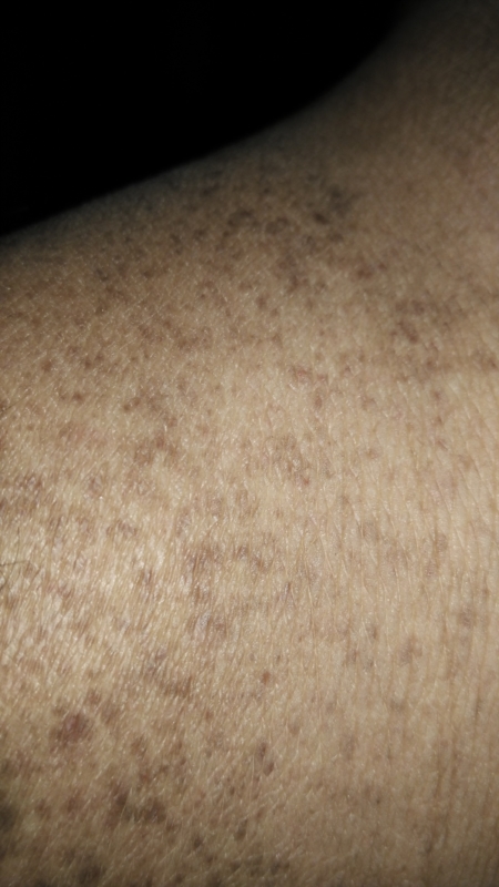 brown-spots-above-and-around-left-ankle-dermatology-skin-and-nails