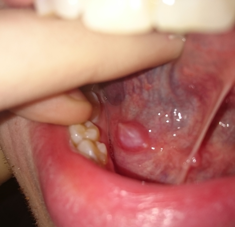 Under small tongue ball Bumps On