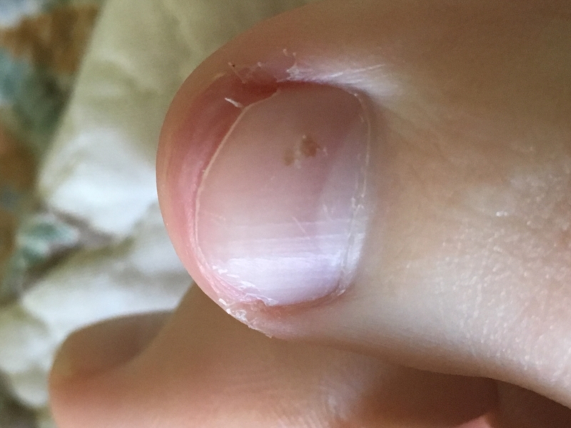 Light brown spot underneath toe nail? | Dermatology ...