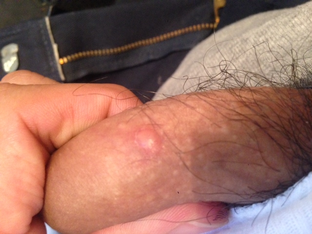 Blister on shaft of your penis