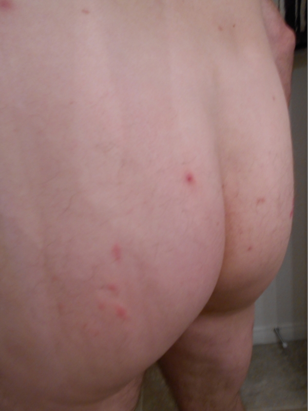 I Have Bumps On My Butt 80