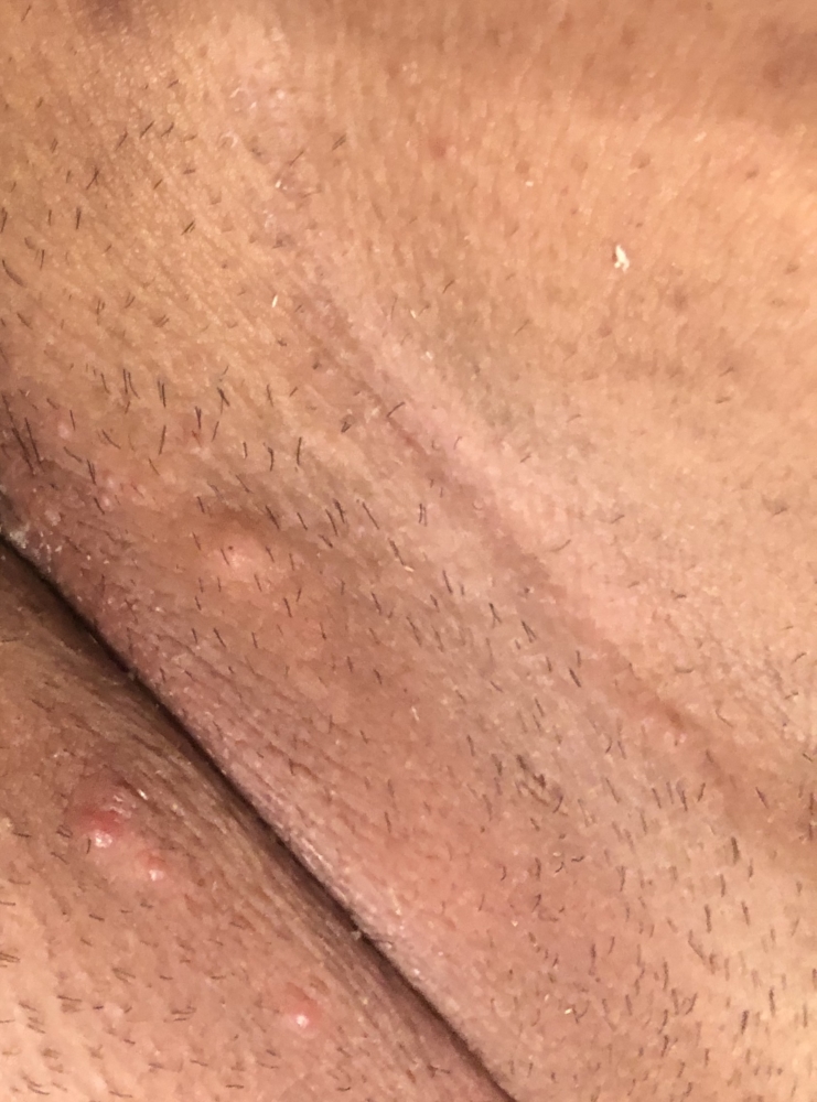 Ingrown Hair Or Herpes Genital