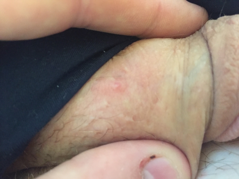 Herpes on penile shaft pictures