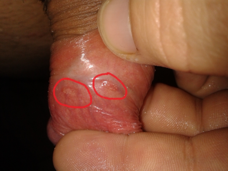 Three little bumps on penis foreskin.