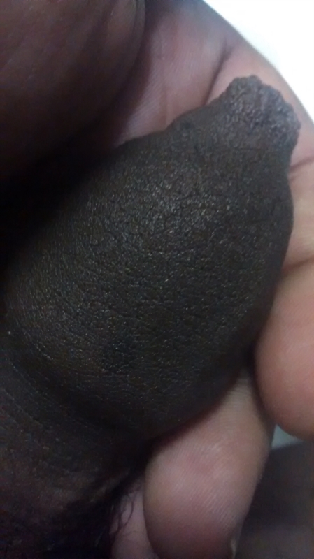Black Skin On Penis 86
