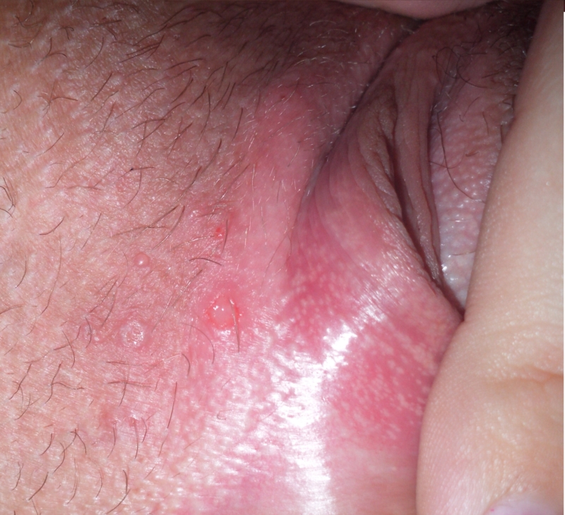 What's causing itchy bumps near my vagina
