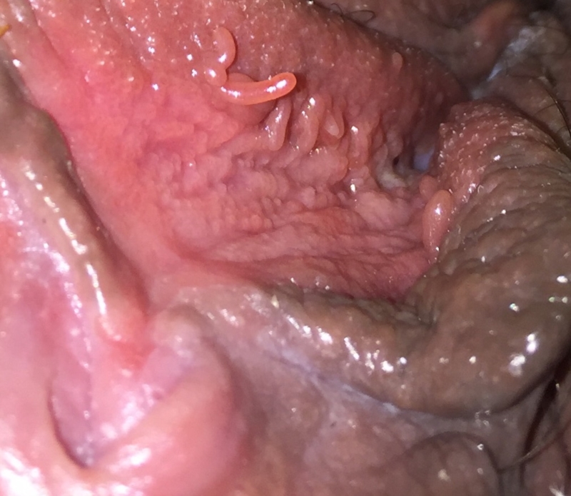 HPV-fertőzés tünetei és kezelése - HáziPatika, Hpv herpesz be