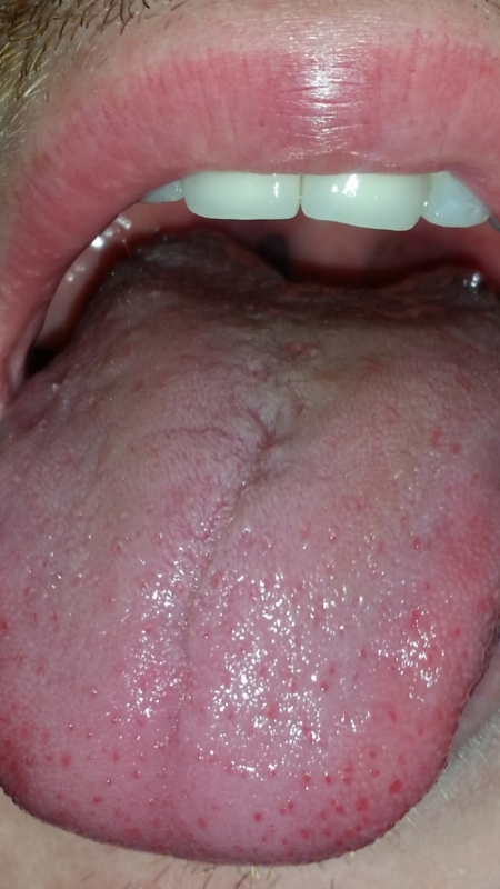 red spots on tongue, is it oral thrush? | Fungal and Yeast ...