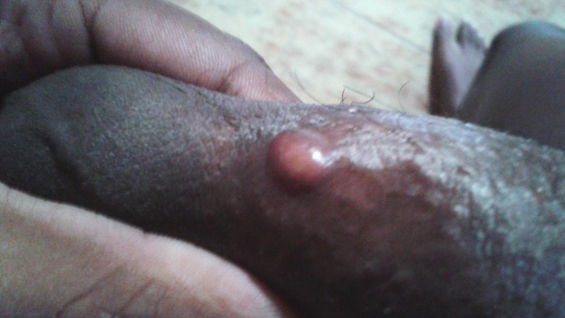 Cysts On Penis Pictures 12