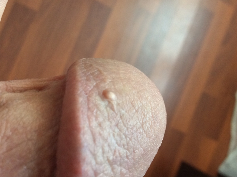 Small Cut On Penis 110