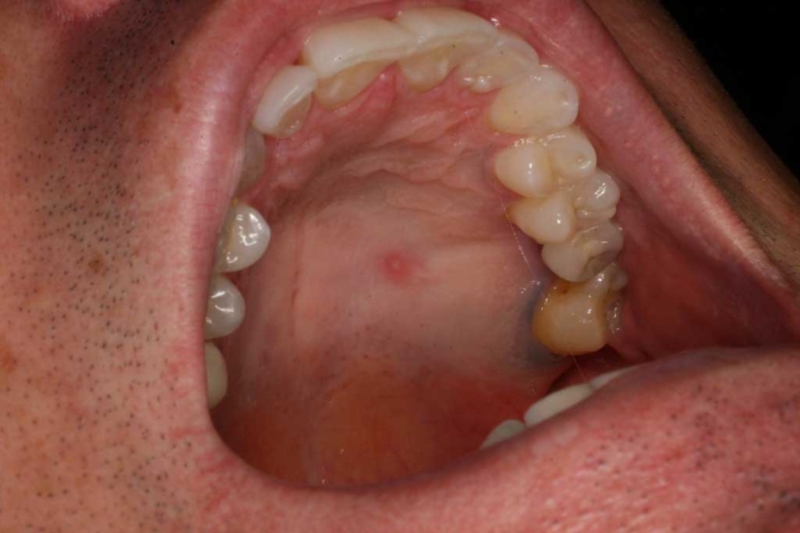 Hard Lump Roof Of Mouth 40