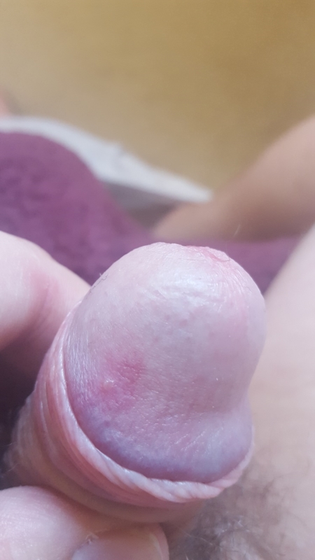 White Spot On My Penis 3
