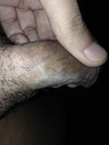 Red Spot On Shaft Of Penis 103