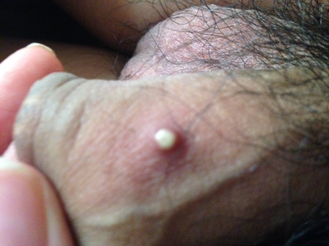 one zit on my penis.