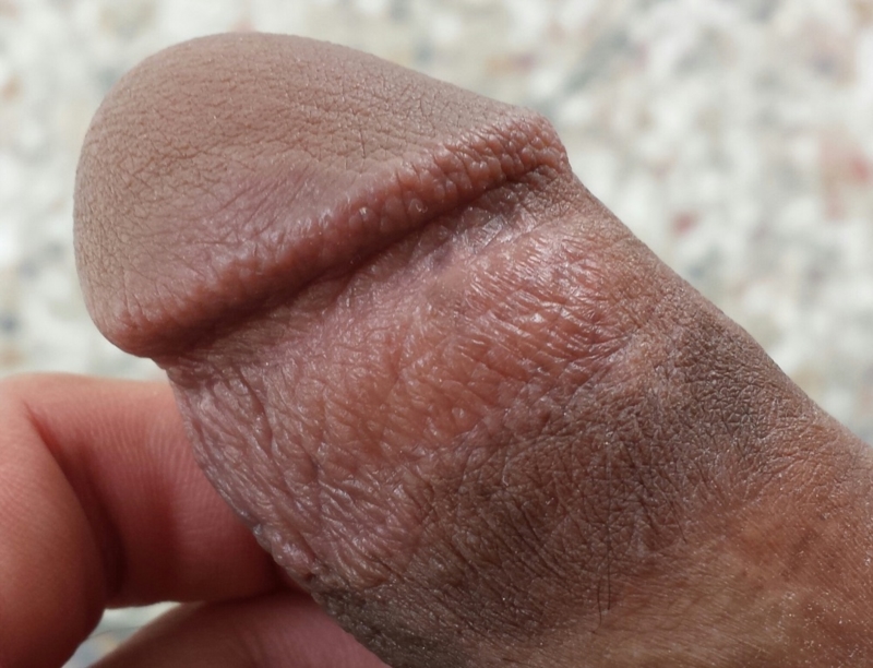 Dry peeling penis skin solution