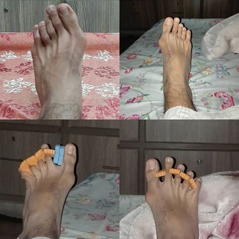 soccer surgery bunions anybody bunion done playing experience football after patient forums replies likes
