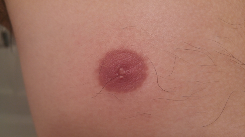 Male on nipple white bump Why is