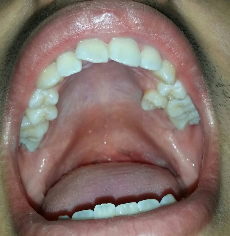 Premolar On Roof Of My Mouth Pic Oral And Dental Problems Forums