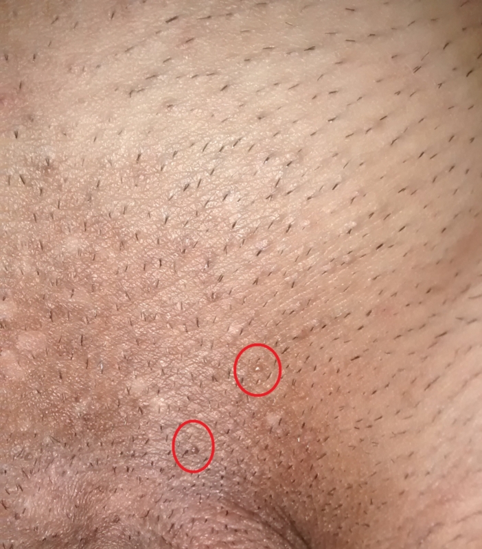 About Anal Genetal Warts Quality Porn