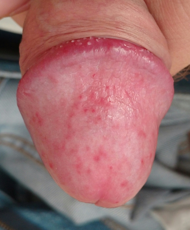 A red rash on penis glans