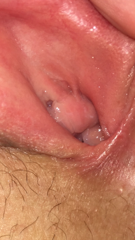 450px x 800px - Herpes simplex vagina â€” Domination Porn Pics