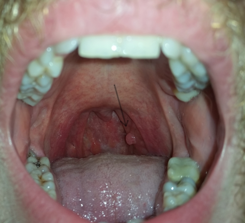 throat-cancer-picture