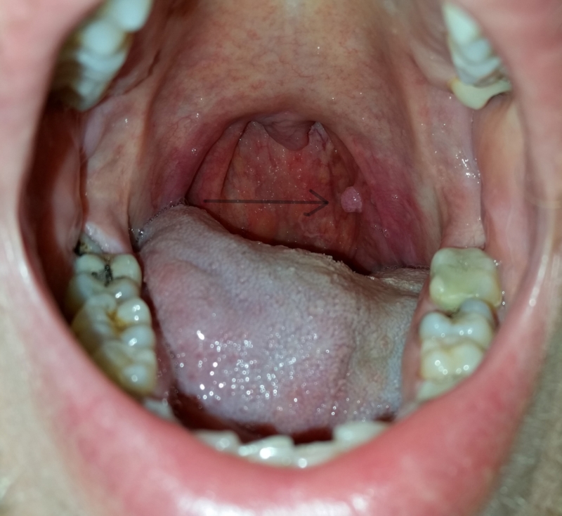 Throat Pic 19