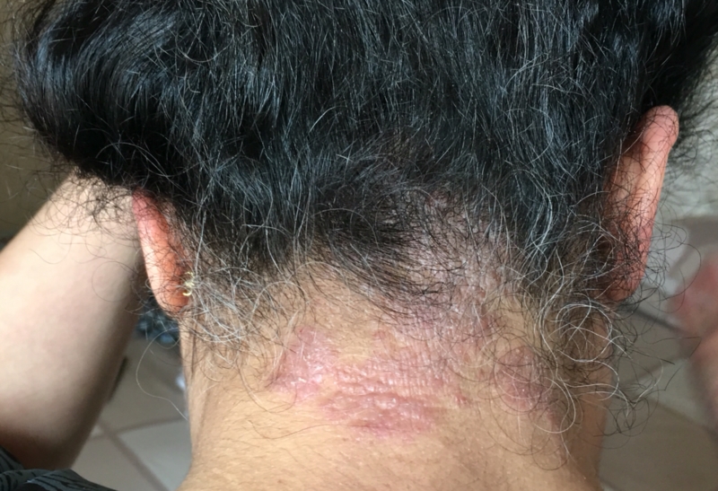 Please Help Me With This Behind My Neck And Hairline Eczema 