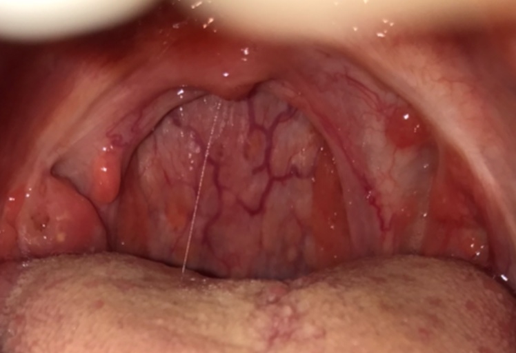 Red Bumps At Back Of Throat 51
