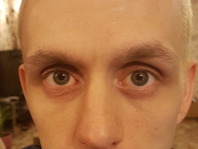 Wrinkled And Red Under Eyes | Forums Patient