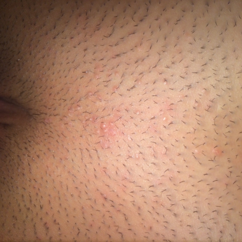 Red Itchy Bumps on Pubic Area *PICTURE* PLUS BLEEDING | Other Conditions  and General Health | Forums | Patient