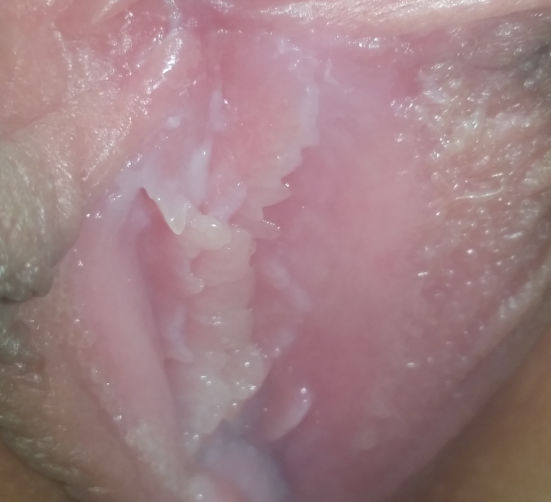 What Is Wrong With My Vagina Herpes Pictures  Sexual -3193