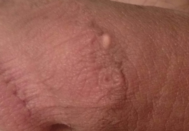 Cyst On Penis Shaft 20