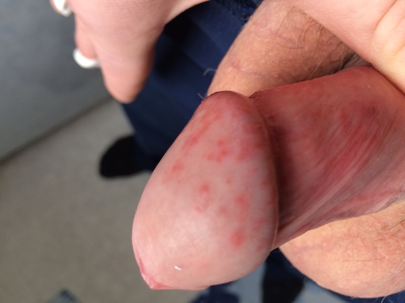 Pearly penile papules are benign flesh-colored, pinkish, or white bumps und...