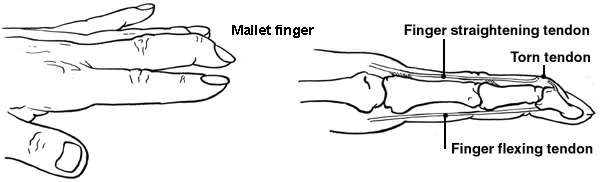 Diagram of the hand showing mallet finger