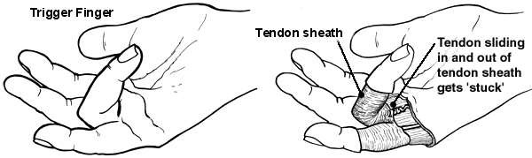 Diagram of the hand showing trigger finger