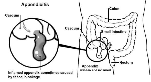 Diagram of the bowel showing an inflamed appendix