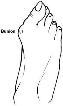 Diagram of the foot showing a bunion