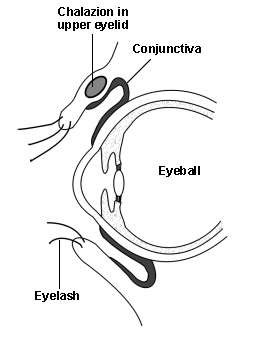 Cross-section diagram of an eye with chalazion in the upper eyelid