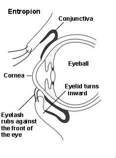 Cross-section diagram of an eye showing an entropion