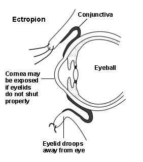 Cross-section diagram of an eye showing an ectropion