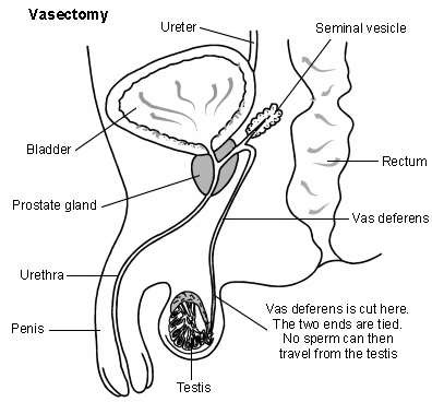 Cross-section of the male reproductive organs showing how a vasectomy is done